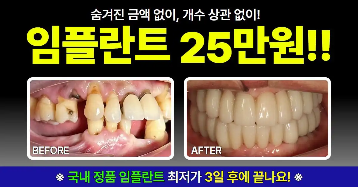 국산 정품 임플란트 개당 25만원 안내 배너